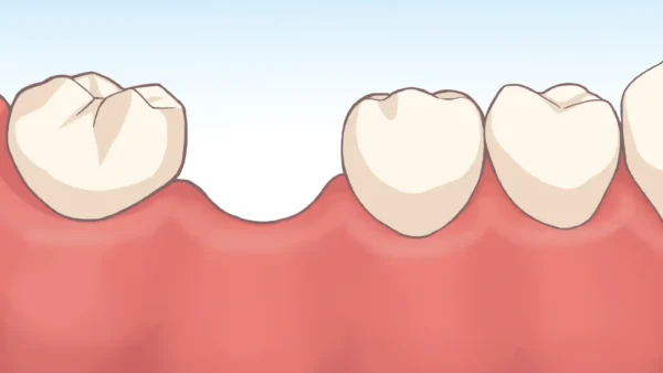 歯を失った際の治療方法について