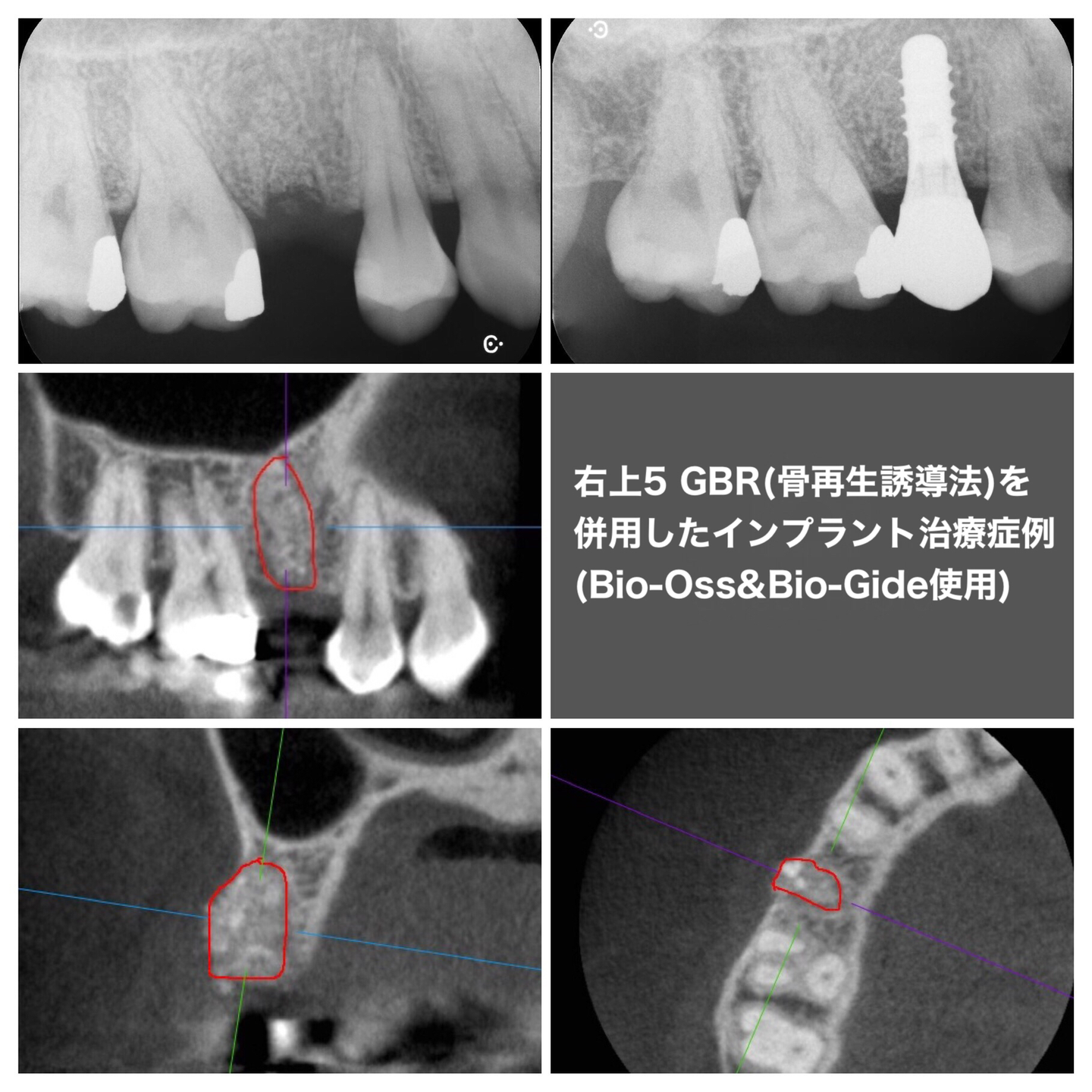 骨を増やす処置とインプラント
