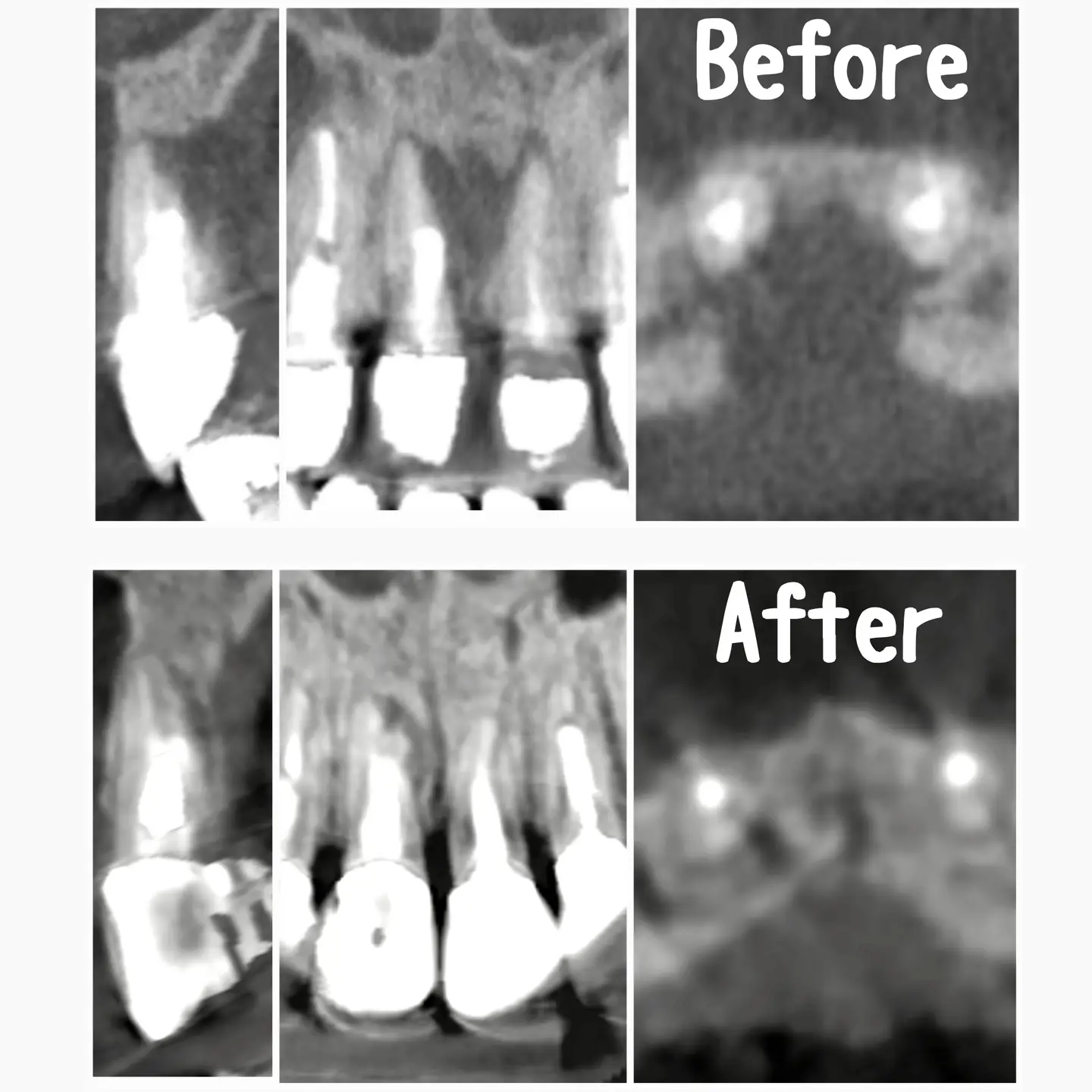 感染根管治療及びMTAセメントによる穿孔封鎖