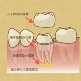 むし歯治療後の歯の寿命について