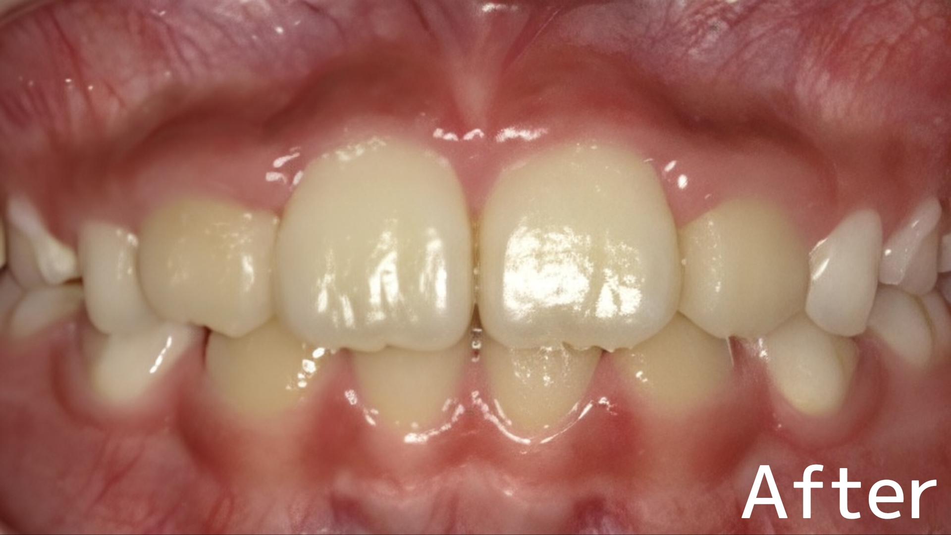 After image