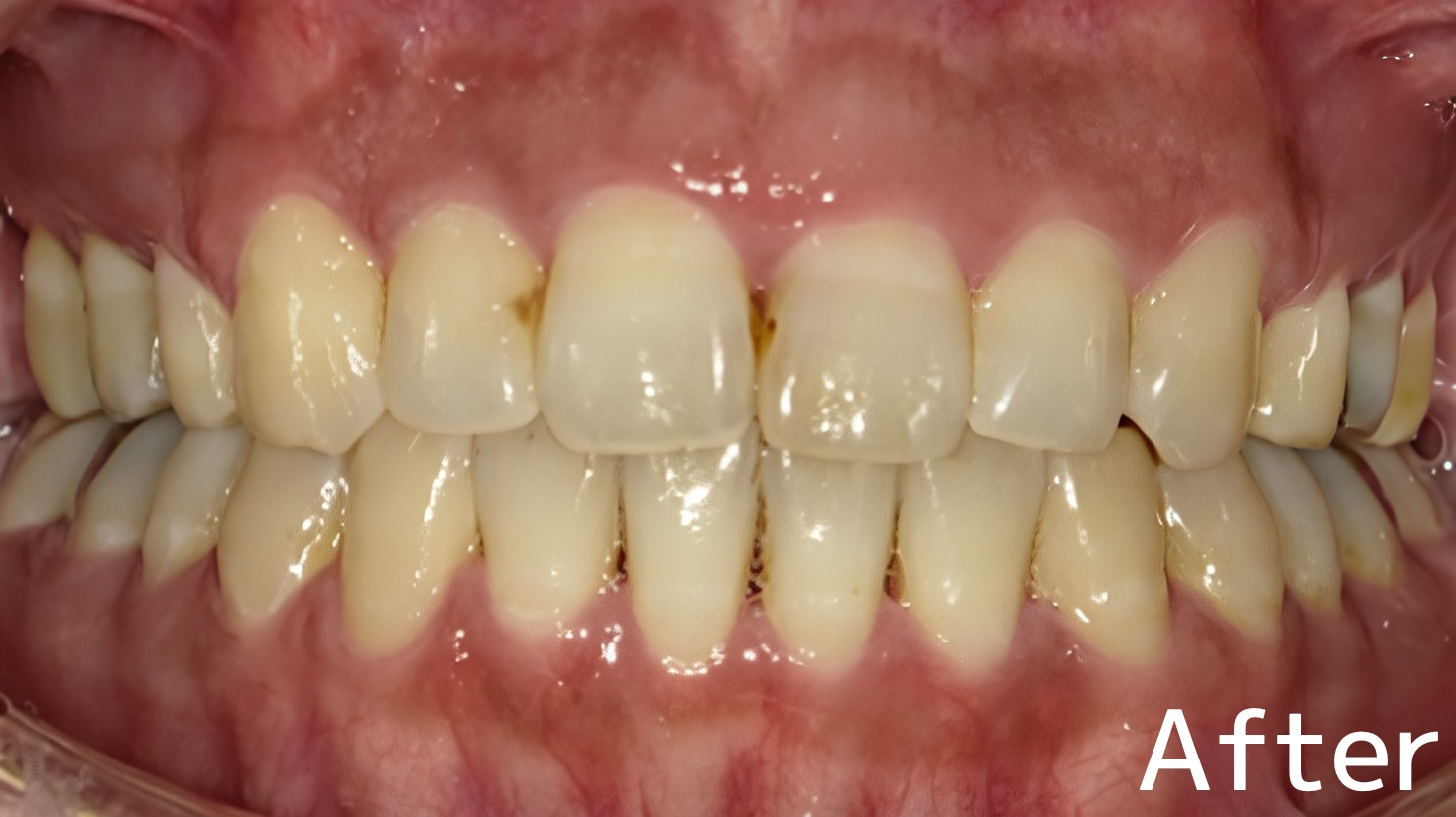 After image