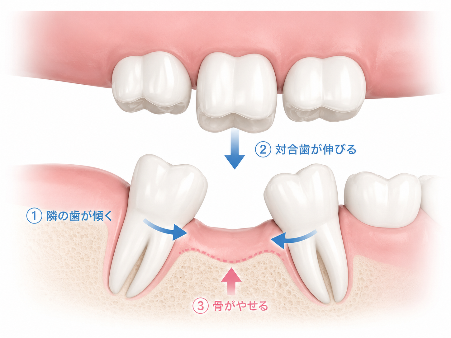 歯を失ったまま放置した際に起きる3つのリスク（歯の傾き・挺出・骨吸収）の図解