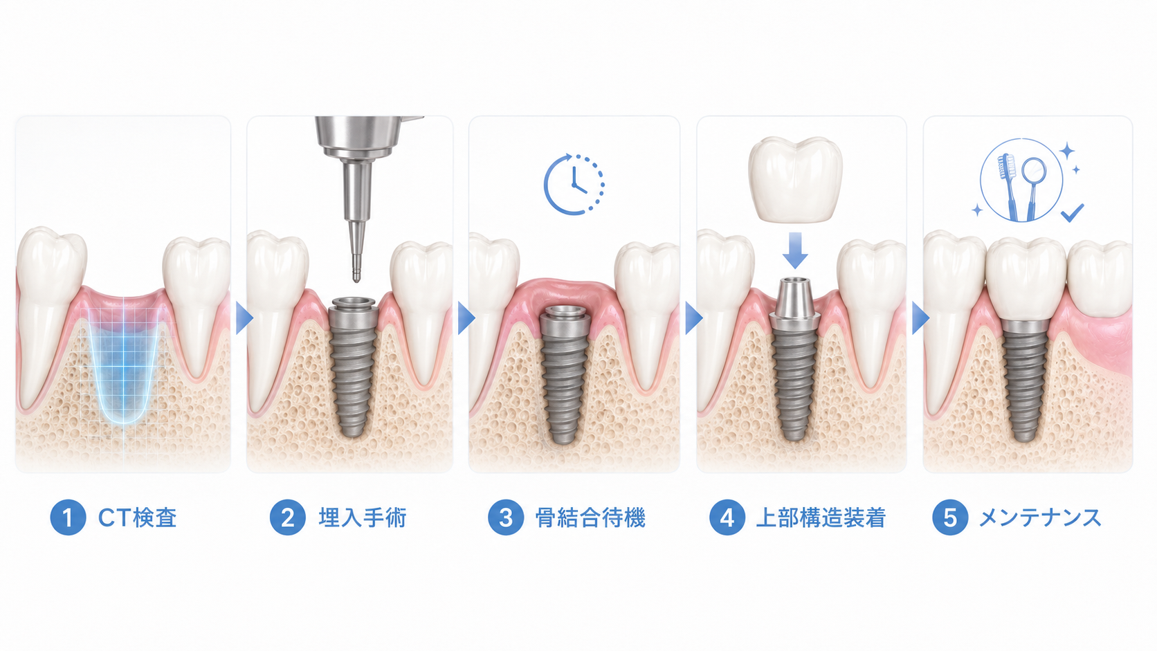 インプラント治療の流れ：CT検査→手術→骨結合→上部構造装着